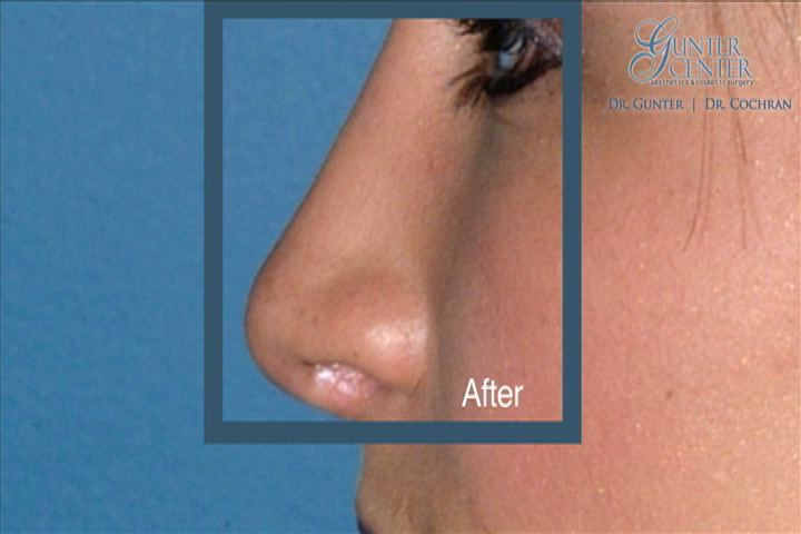 Penis enhancement surgery in fort worth texas - Flaredclean.ga
