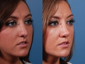 Bulbous Tip Rhinoplasty