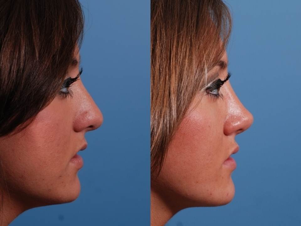 Bulbous Tip Rhinoplasty